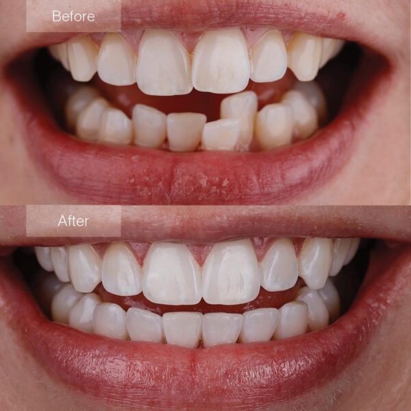 Invisalign 11