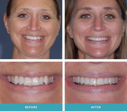 Invisalign 12