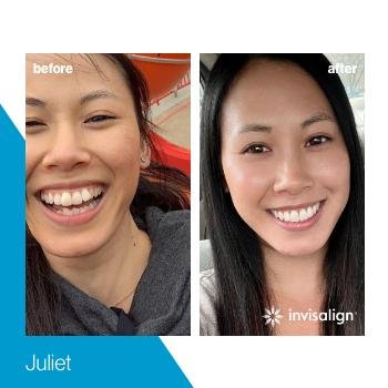 Invisalign 13