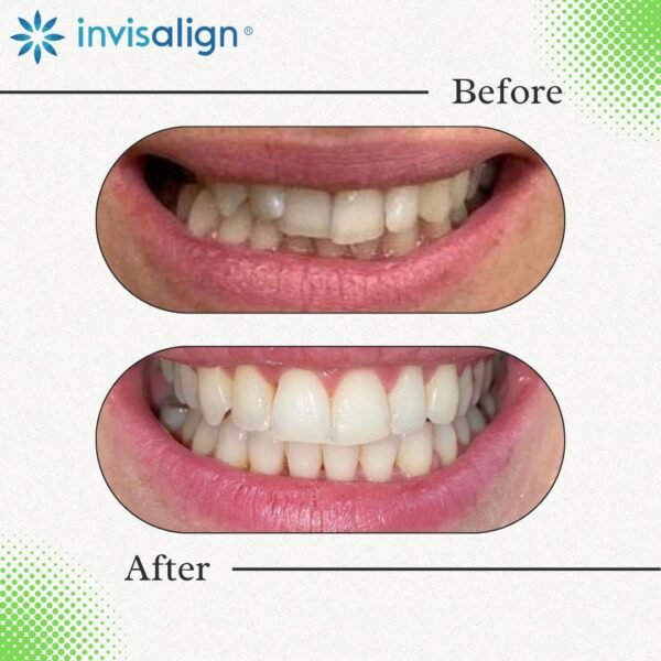 Invisalign 14