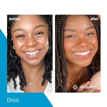 Invisalign 15